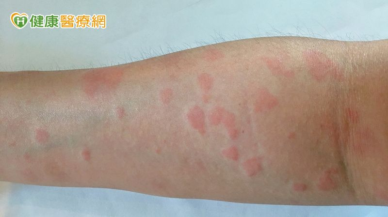 全身性紅斑性狼瘡（Systemic Lupus Erythematosus，SLE）是一種常見的自體免疫疾病，患者的免疫系統會錯把自身組織當成外來物攻擊，導致慢性發炎與器官損傷。