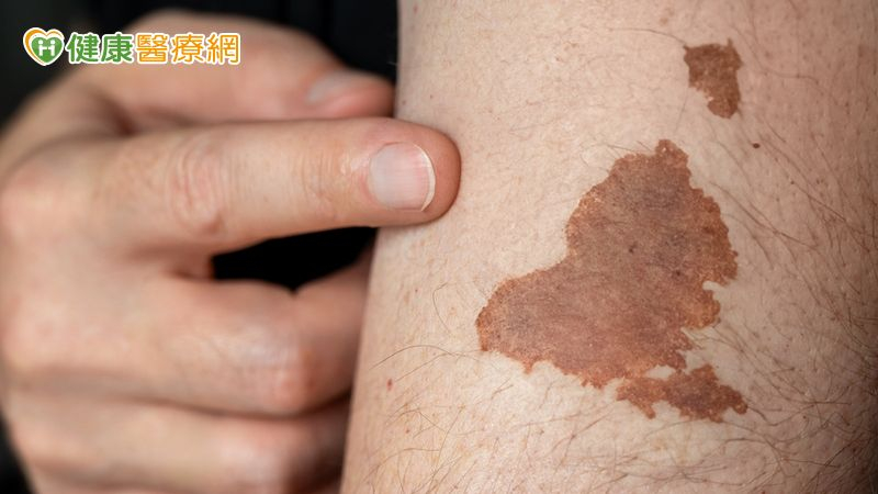 基底細胞癌也可能發生在軀幹，身體若發現異常斑塊甚至不明黑色線條，也請儘早就醫排除惡性變化。