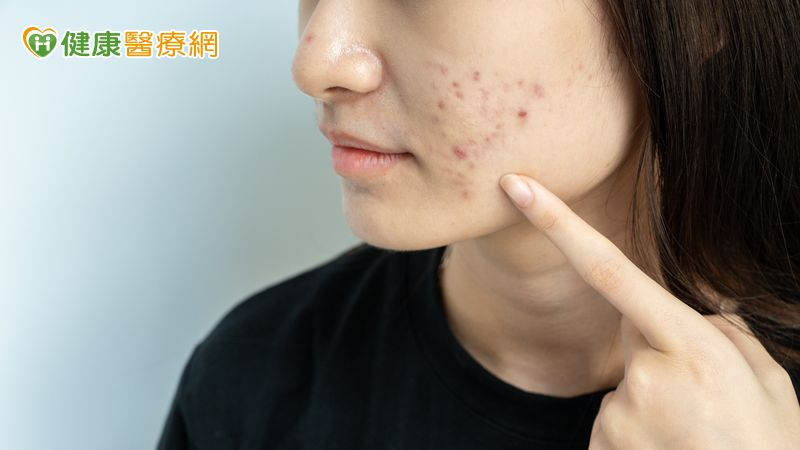 若想要在換季期間避免痘痘反覆出現，需同時從保養、飲食與生活習慣三方面著手。勤於保濕、飲食節制與規律運動，是維持肌膚穩定的關鍵。