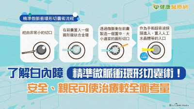 了解白內障「精準微脈衝環形切囊術」！　安全、親民可使治療較全面考量