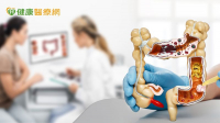 陪夫健檢6旬婦意外發現大腸癌　自然孔微創手術成功切除