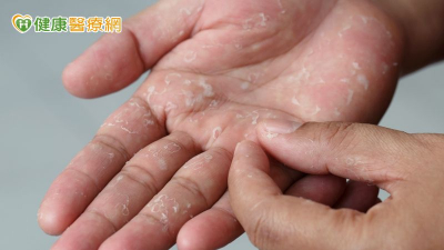 汗皰疹起水泡癢到無法工作　中醫分型調理體質助重返崗位