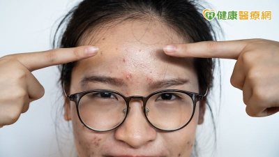 輕熟女滿臉痘？　「光動力治療」大幅改善症狀！