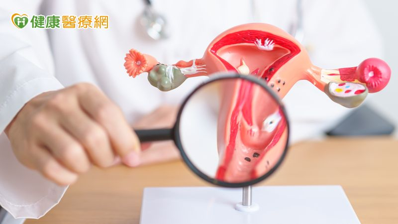 台灣宣布全面升級子宮頸癌防治政策，也就是將子宮頸癌篩檢年齡，下修至 25 歲、並新增 35、45、65 歲 HPV 檢測。