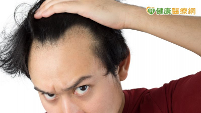 35歲男髮際線後退「M型禿」！中醫「1治療」改善掉髮、新髮冒出