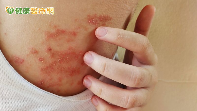 異位性皮膚炎不再是無止盡的搔癢，而是一段學會與身體和平共處的旅程。 