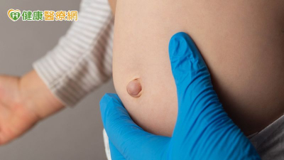 肚臍疝氣恐讓懷孕有危機　醫：觀察肚臍「有這狀況」早期診治