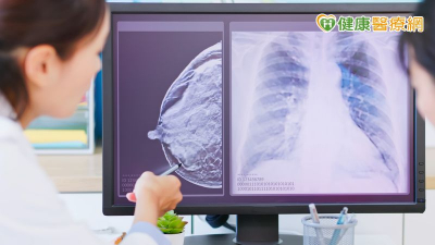 51歲婦乳房摸到硬塊確診乳癌　乳房保留手術結合新型放射治療降復發