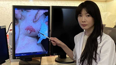 暖暖包放乳溝9H　淺二級燙傷