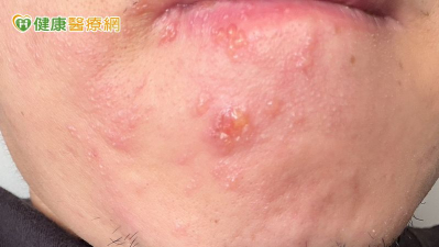 牙痛失眠三天竟「皮蛇」爬滿臉！醫：免疫力斷層恐致帶狀皰疹發作