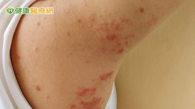 背痛到像被火燒竟是帶狀皰疹！醫：「這樣做」可大幅降低復發與後遺症