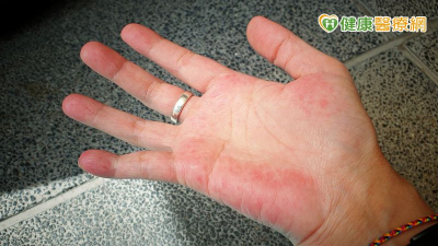 紅斑性狼瘡折磨睡不著、傷口難癒　高壓氧治療助改善症狀