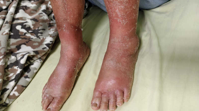 7旬嬤雙腳腫痛「抗生素治療」不見起色 北榮桃園分院揭真相