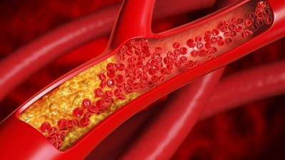 預防心血管疾病，膽固醇降越低越好？研究揭：膽固醇出現「這種變化」，失智風險竟大增
