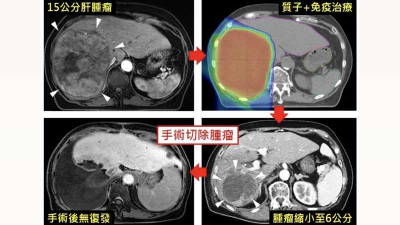 林口長庚質子合併免疫治療奏效　中晚期肝癌生機重現存活率達77%
