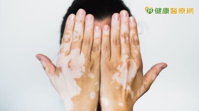 白斑症不只影響外觀　專家：醫療與心理支持並行　精準治療成關注焦點