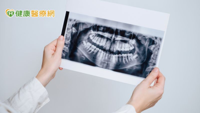 【健保30週年專輯】牙科診斷性 X 光暴露與良性及惡性腦瘤風險之關聯