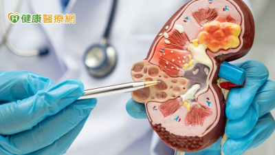 【健保30週年專輯】多囊腎患者罹患癌症之風險：以全國人口為基礎、採用傾向分數配對分析之世代研究