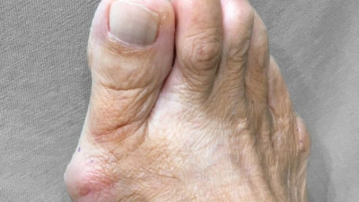 拇指外翻痛起來要人命！醫破解拇指外翻手術「2大」迷思、術後照護「3要點」