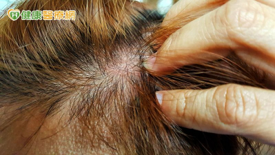 癌友頭皮長皮疹、潰瘍怎麼辦？護理師教正確照護4步驟