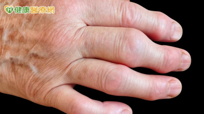 類風濕性關節炎造成手指腫痛變形  「 微細動脈栓塞 」介入可緩疼痛