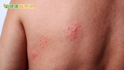皮膚病一定能「斷根」？醫破解過敏、香港腳與帶狀皰疹常見迷思