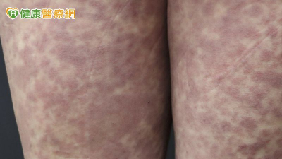 37歲女吃藥發燒出疹　檢測揪出複方藥「這成分」致敏