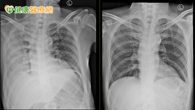 59歲男突然發燒「血氧僅82%」！確診新冠重症　醫示警「3症狀」別拖