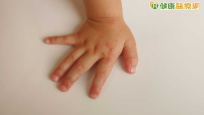 重症添1例！未滿10歲女童先發燒後雙腿無力確診腸病毒　疾管署示警