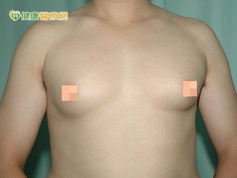 他狂健身變 大咪咪 男性女乳症作祟 健康醫療網 健康養生新聞資訊網路媒體