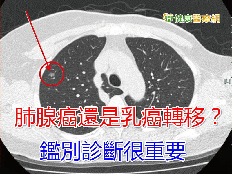 肺腺癌還是乳癌轉移？　鑑別診斷很重要