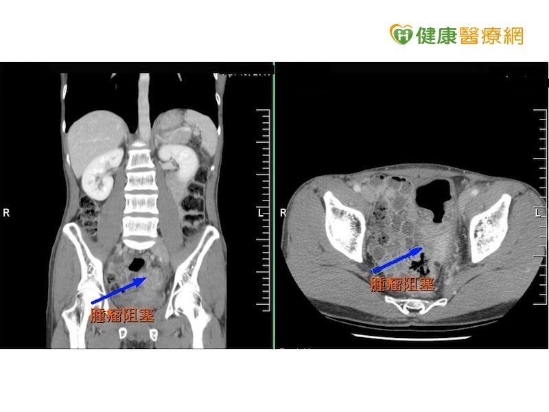 大腸癌年輕化　腹脹血便是徵兆