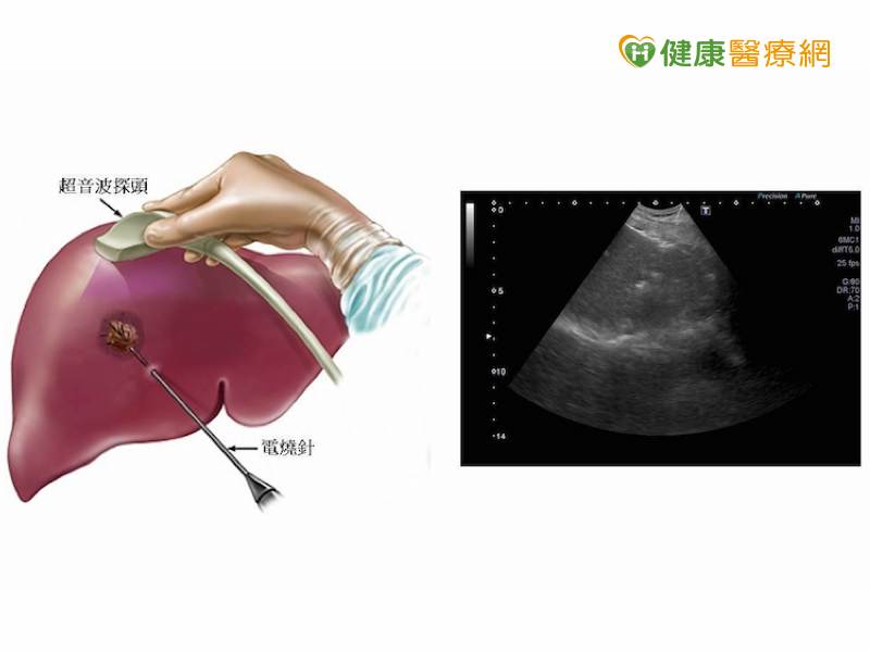 他b肝帶原30年竟演變成肝癌 健康醫療網 健康養生新聞資訊網路媒體