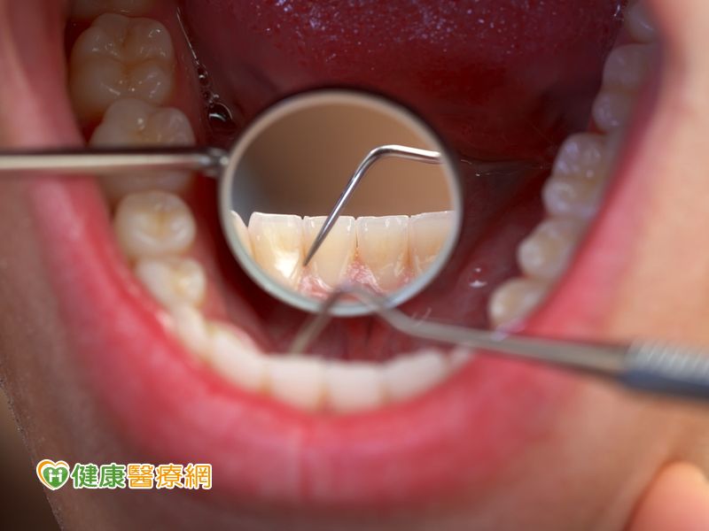 還在用醋洗牙結石 正確潔牙卡實在 健康醫療網 健康養生新聞資訊網路媒體