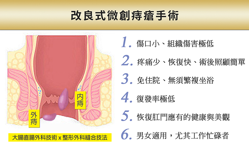 新一代改良式微創痔瘡手術可合併其他手術同日完成 健康醫療網 健康養生新聞資訊網路媒體
