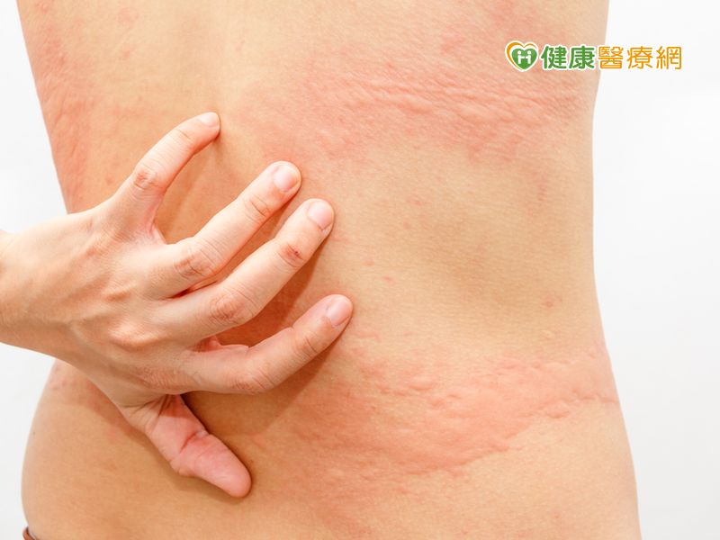 麻疹 性病 蕁