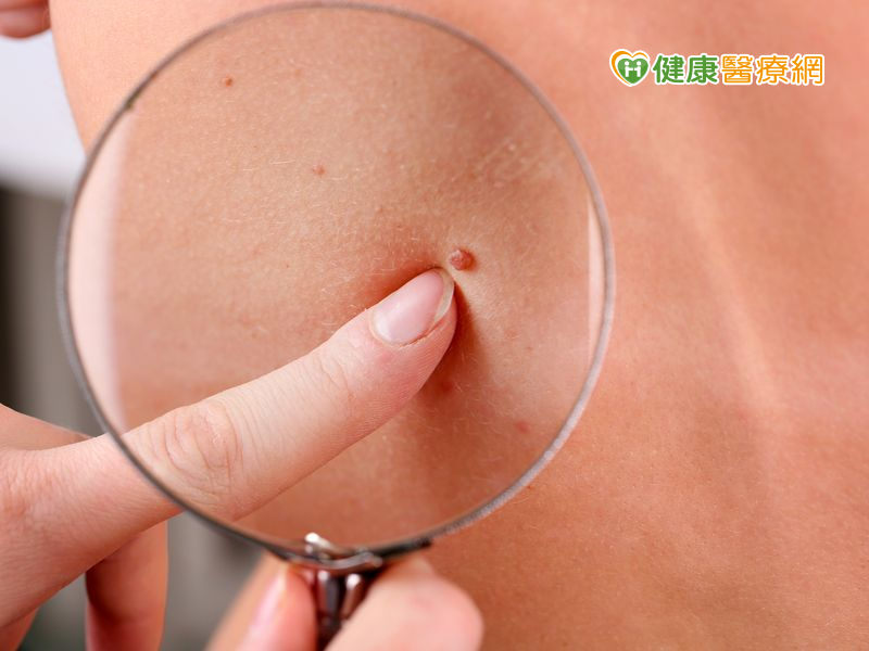 防治皮膚癌　發現這四徵兆速就醫