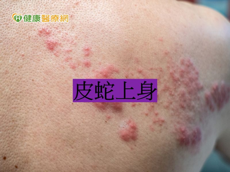 壓力大年輕人皮蛇上身 健康醫療網 健康養生新聞資訊網路媒體 壓力大年輕人皮蛇上身 健康醫療網 健康養生新聞資訊網路媒體