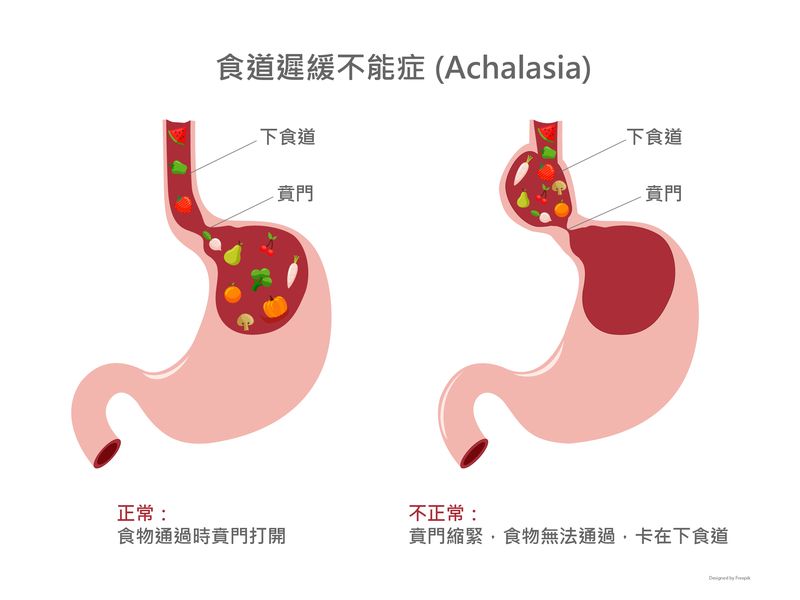 食道弛緩不能症(Achalasia)～與賁門鬆弛(GERD)剛好相反