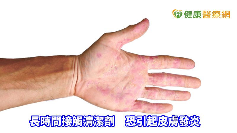 要避免誘發接觸性皮膚炎，民眾不妨戴合適的手套，且除了長度要夠長，也應依照接觸物質選擇具防護力的手套。