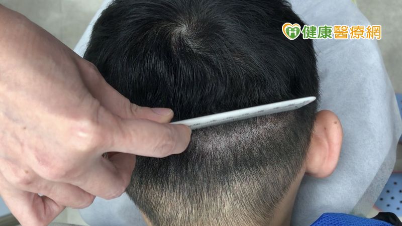 患者透過SMP擬真髮頭皮微點染色療程，成功修飾疤痕。