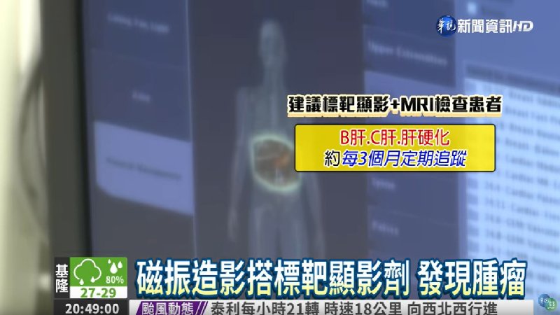 磁振造影查肝癌　準確率逾9成