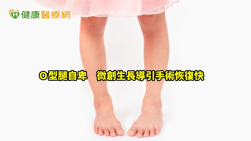 適合較不嚴重的Ｏ型腿或Ｘ型腿，如果變形太嚴重還是得用切骨矯正。