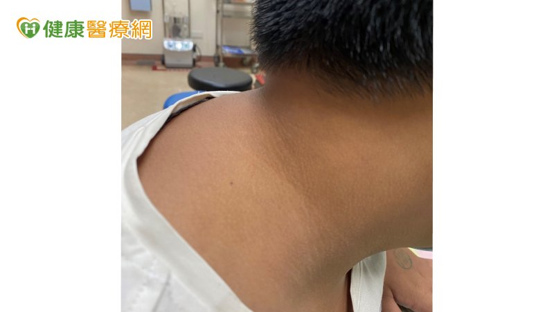 「黑色棘皮症」脖子後方呈黑色暗沉狀。