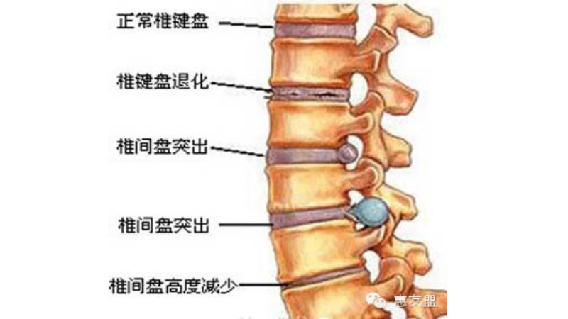 椎間盤突出（HIVD）真的需要開刀嗎？