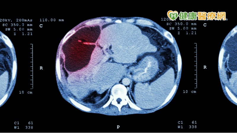 肝癌判定有難度　積極追蹤更安心