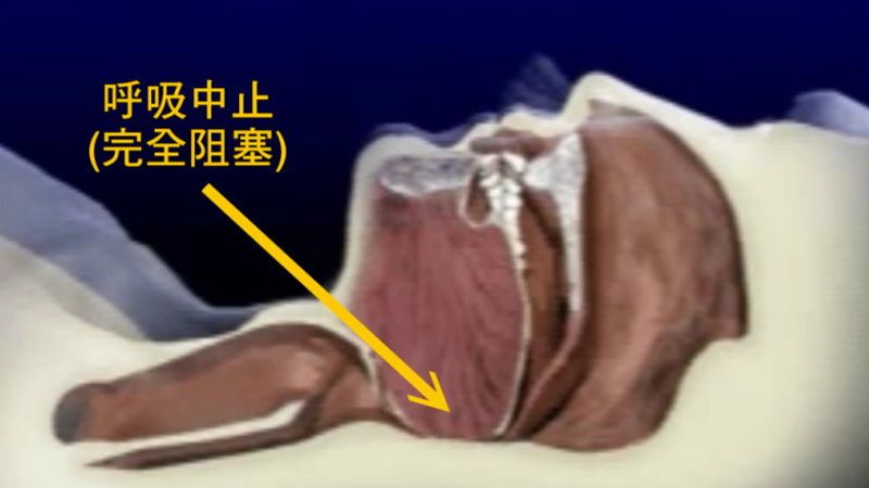 睡眠呼吸中止與聽力損失的關係