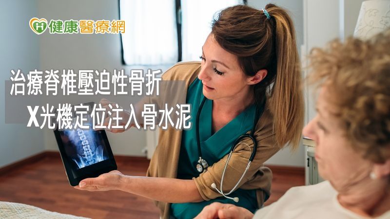 「經皮穿刺椎體成形術」使用微創方式,將骨水泥注入發生骨折的椎體,穩定壓迫的椎體,提供病人因骨質疏鬆而造成壓迫性骨折另一種治療選擇。