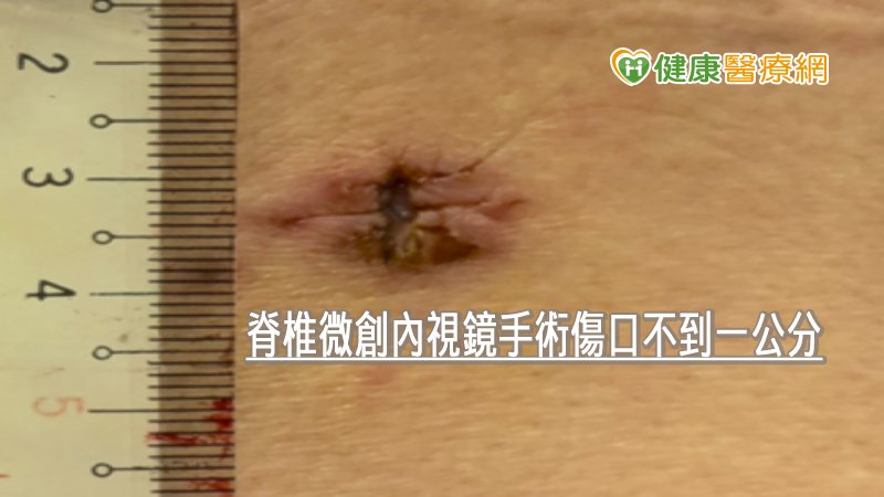 脊椎微創內視鏡是更進一步將手術工具通道與內視鏡整合在一個不到一公分的管道中，這個管道穿過背部肌肉時，可將肌肉推開而不需切斷，減少術後的背痛，復原快。由於對骨骼構造破壞小，不需要在體內加上骨釘與墊片，減少術後背痛及鄰近節退化的後遺症。