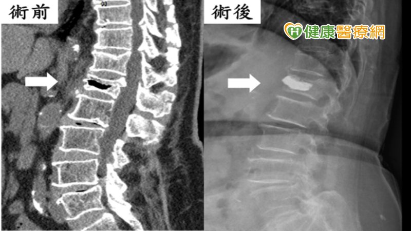 左圖可見術前椎體明顯扁掉(壓迫性骨折)，且內部有空洞(黑影處)，經骨水泥填充後(右圖)，可支撐脊椎骨折，減輕不適感。